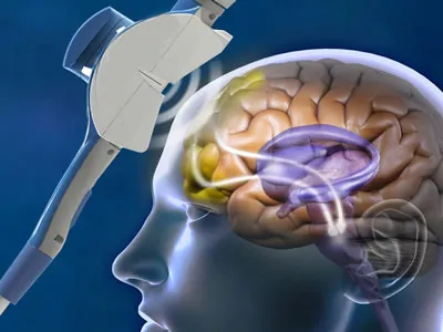 psiquiatra eletroconvulsoterapia em brasilia df